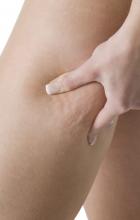 lipolyse laser lipolyse laser