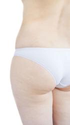 Cellulite Cellulite