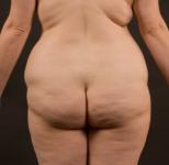 Lipotomie Lipotomie