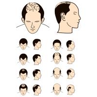 Greffe de cheveux Greffe de cheveux
