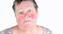 lesions vasculaires benignes lesions vasculaires benignes
