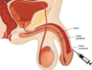 Procédure d'augmentation du gland Procédure d'augmentation du gland