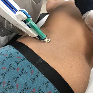 traitement cellulite méso cellulite Lille traitement cellulite méso cellulite Lille