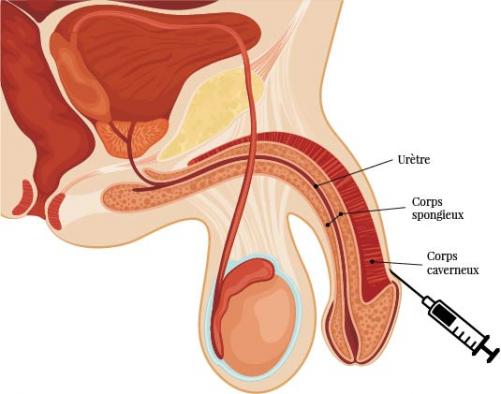 opération gland